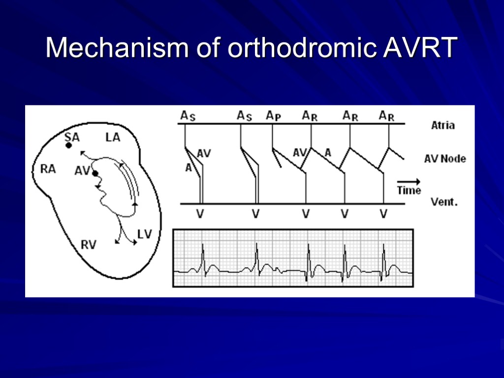 Mechanism of orthodromic AVRT